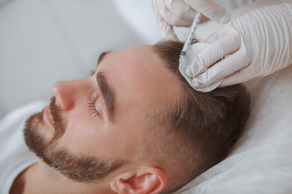 A healthcare professional administers a hair restoration treatment using a syringe on a male patient&apos;s scalp. The patient is lying down, appearing relaxed, with a focused expression. The procedure is likely related to hair loss solutions, such as PRP (Platelet-Rich Plasma) therapy, which is gaining popularity for promoting hair growth. The setting is a clinical environment, emphasizing a professional and safe approach to cosmetic procedures. This image highlights advancements in aesthetic treatments and the growing interest in non-surgical hair restoration options.