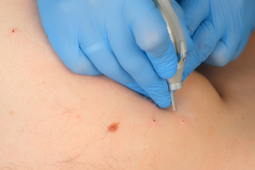 A healthcare professional wearing blue gloves performs a skin treatment using a precision tool on a patient&apos;s body. The image shows close-up details of the skin, highlighting small marks and a mole, indicating a dermatological procedure. This visual representation emphasizes the importance of professional skin care and the use of specialized equipment in dermatology.