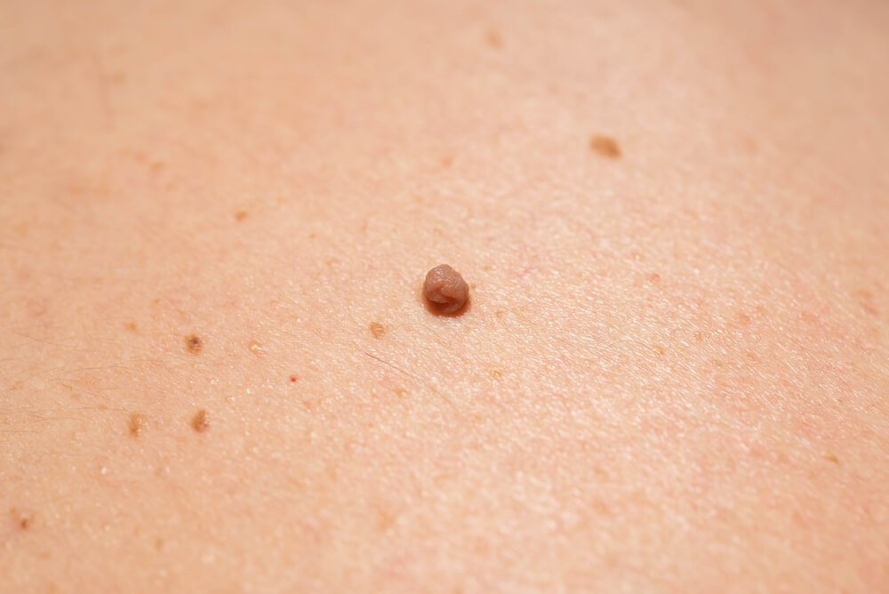 Close-up image of a small brown mole on light skin, showcasing the texture and color contrast against the surrounding skin. The mole is round and slightly raised, with a smooth surface. This image may be used in discussions about skin health, dermatology, or self-examination for potential changes in moles. Proper skin care and regular check-ups with a dermatologist are essential for monitoring skin conditions.
