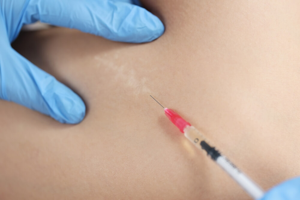 A healthcare professional in blue gloves prepares to administer an injection into the skin, focusing on a specific area showing stretch marks. The syringe has a pink cap and is positioned close to the skin&apos;s surface. This image illustrates a medical procedure related to skin treatment or cosmetic enhancement, highlighting the importance of professional care in addressing skin concerns.