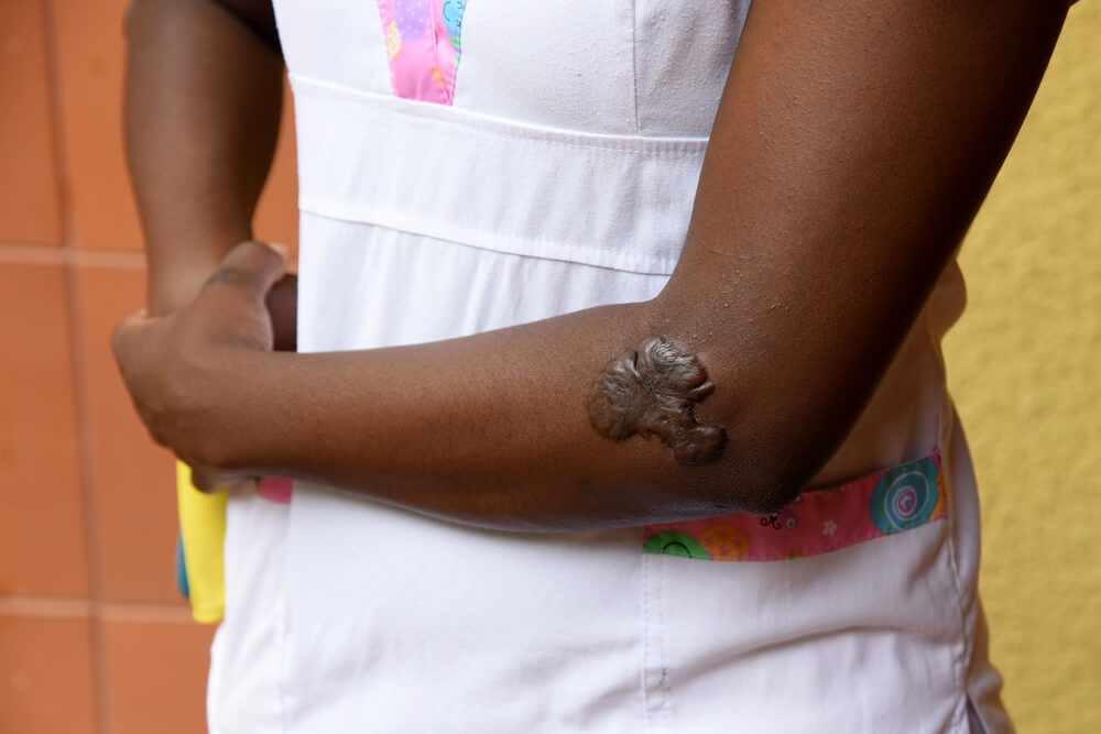 Image of a person with a brown skin tone, showing their arm with a prominent scar or keloid on the elbow. The individual is wearing a white shirt with colorful patterns on the pocket. The background is a warm, neutral color, enhancing the focus on the arm and the texture of the skin. This image highlights the uniqueness of skin variations and the importance of skin health awareness.