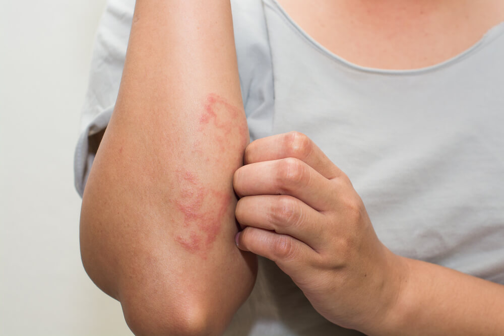 young lady suffering with eczema