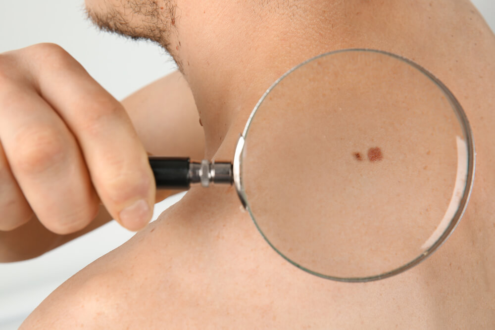 Person examining a mole on their shoulder with a magnifying glass, highlighting skin health and the importance of monitoring moles for changes. This image emphasizes skin care awareness and the need for regular skin checks to detect potential issues early.