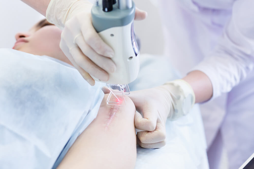 A healthcare professional wearing gloves operates a laser device on a patient&apos;s arm, which has a visible scar. The patient is lying on a treatment table, appearing relaxed as the laser targets the scar for potential cosmetic improvement. The setting is a clinical environment, emphasizing advanced skincare technology and patient care.