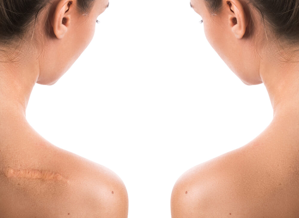 A close-up view of the back of two women, both with long hair styled in a bun, showcasing a prominent scar on one shoulder. The skin appears smooth and healthy, with a light background that emphasizes the scar&apos;s texture and color. This image highlights the human body&apos;s natural variations and may be relevant for discussions on skin health, scar treatment, or body positivity. Ideal for educational content related to dermatology, cosmetic procedures, or personal stories about healing and recovery.