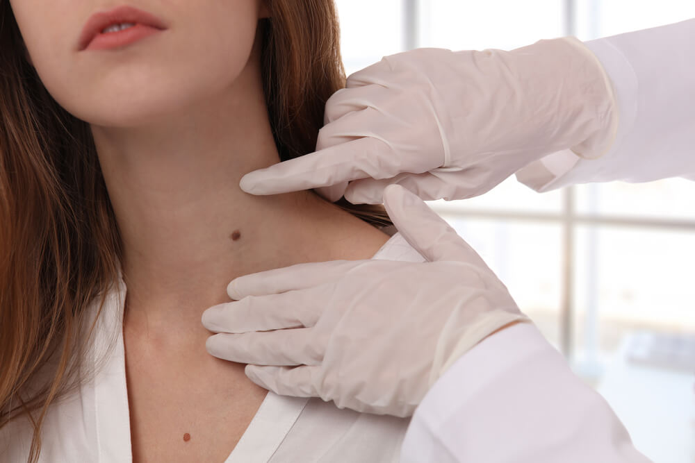 A healthcare professional in gloves examines a woman&apos;s neck, focusing on a mole. The setting is a bright medical office, emphasizing skin health and dermatological assessments. This image highlights the importance of regular skin checks and early detection of potential skin issues, such as melanoma. It serves as a reminder for individuals to consult with healthcare providers for skin evaluations and to monitor any changes in moles or skin conditions.