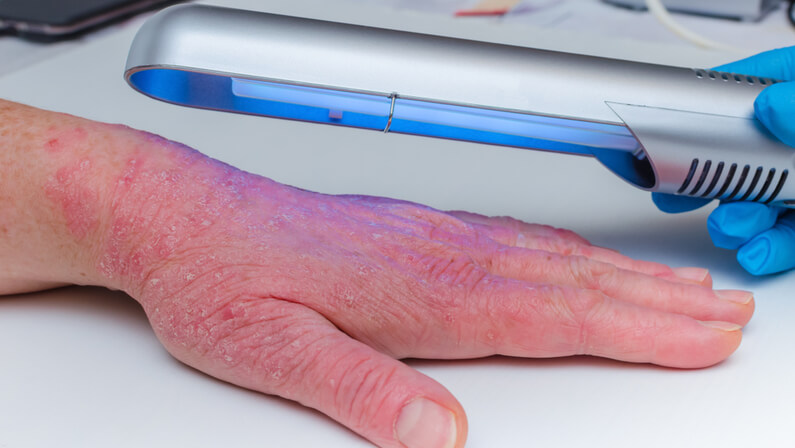 Phototherapy treatment on a patient