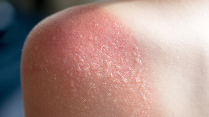 blisters on skin