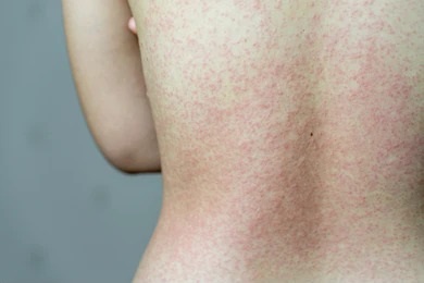 Close-up of a person&apos;s back showing a skin condition characterized by red, raised spots. The image highlights the texture and appearance of the affected area, which may indicate a rash or allergic reaction. The background is neutral, allowing for clear visibility of the skin&apos;s condition. This image can be relevant for discussions on dermatological issues, skin health, or medical advice related to rashes and skin irritations.