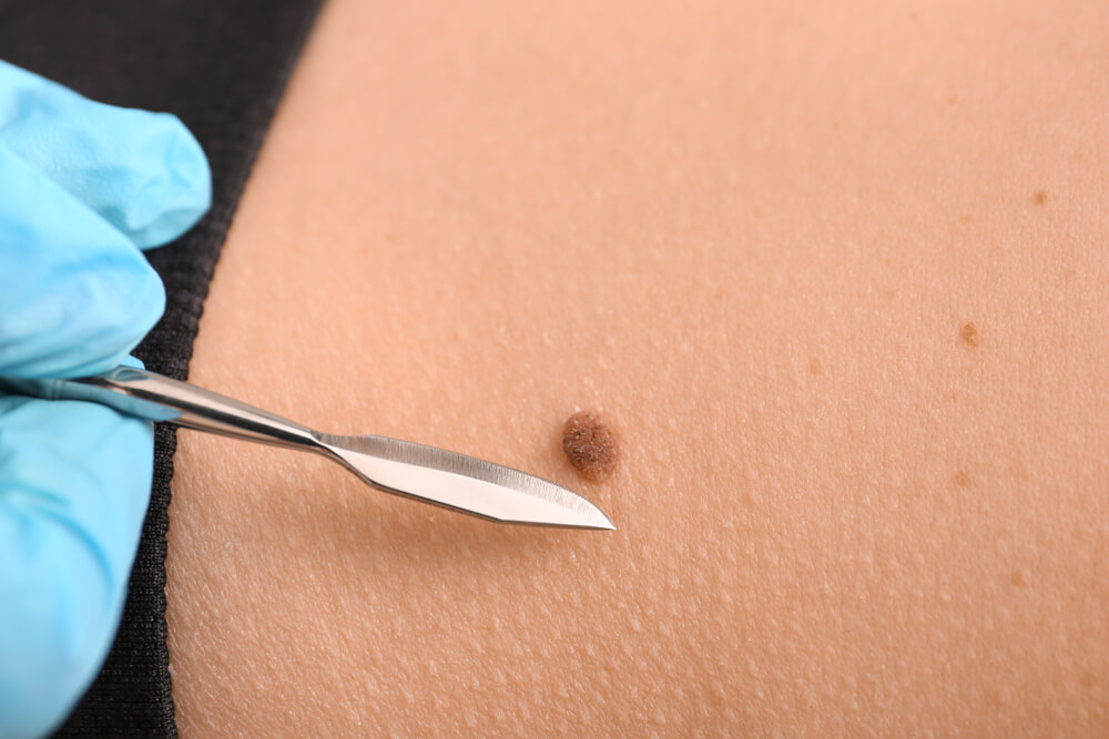 A healthcare professional wearing blue gloves uses a surgical instrument to examine or remove a mole from the skin of a patient’s abdomen. The image highlights the careful process involved in dermatological procedures, emphasizing the importance of skin health and regular check-ups. This visual representation is relevant for articles discussing mole removal, skin care, and dermatology practices, ensuring accessibility for individuals seeking information on skin treatments and health.