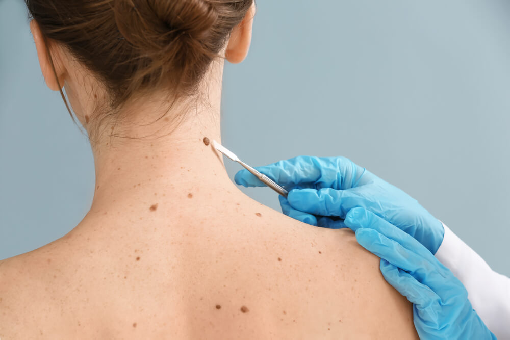 A healthcare professional in blue gloves is examining a patient&apos;s back, focusing on a mole near the neck area. The professional uses a pair of tweezers to assess the mole, which is surrounded by several other skin marks. The image highlights the importance of skin checks for monitoring moles for any changes, an essential aspect of dermatological health. The background is a soft blue, creating a calm environment for the medical procedure. This visual serves as a reminder of the significance of regular skin examinations for early detection