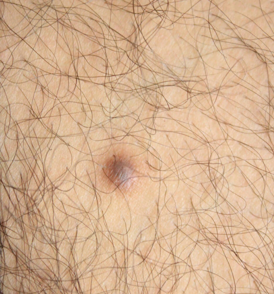 Pilar Cysts