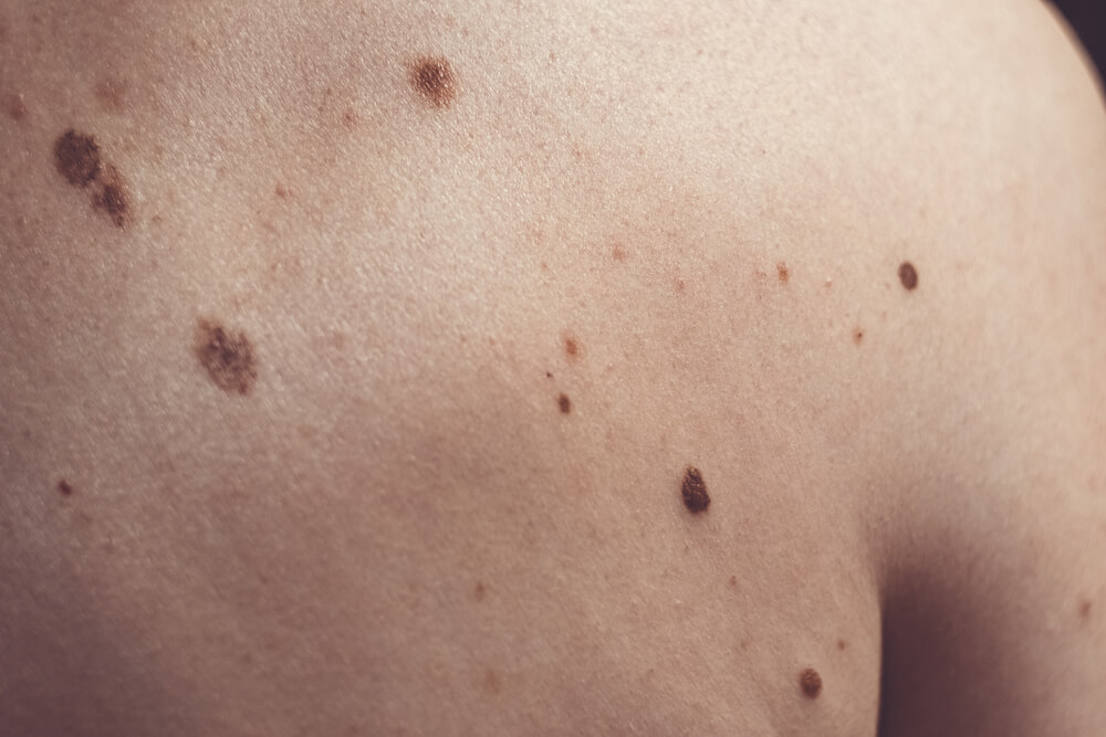 Close-up view of a human back showing various skin moles and pigmentation spots. The skin appears light-toned with multiple dark brown and black moles of different sizes. This image highlights common skin features that can vary in appearance and may require monitoring for any changes. It serves as a reminder for skin health awareness and the importance of regular skin checks for potential changes in moles, which can indicate various skin conditions, including melanoma. Ideal for educational purposes related to dermatology, skin care, and health