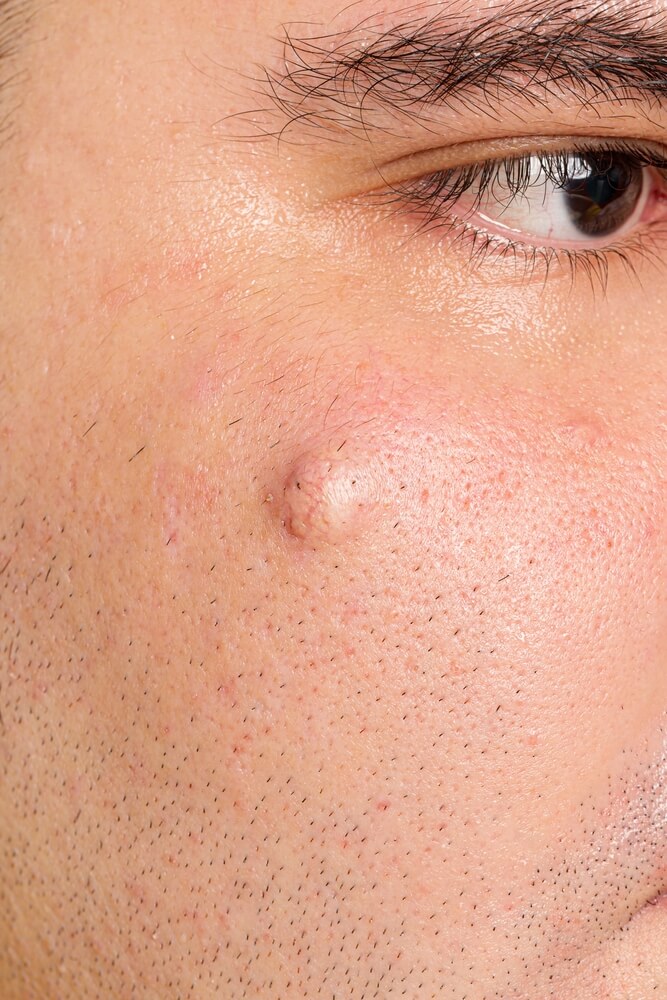 Epidermoid cysts