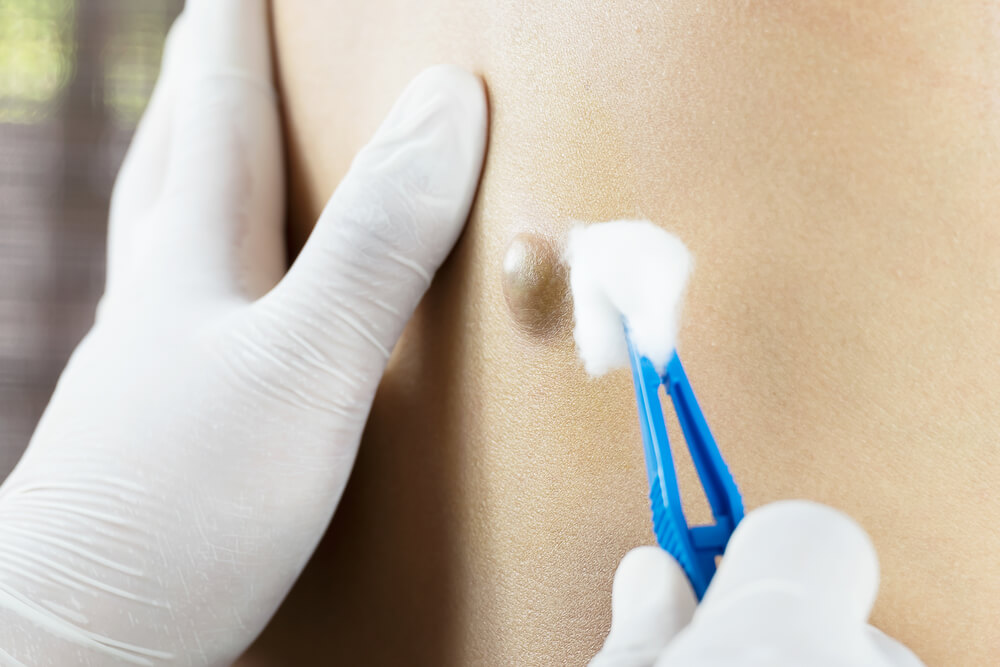 cyst specialist checking a patients cyst