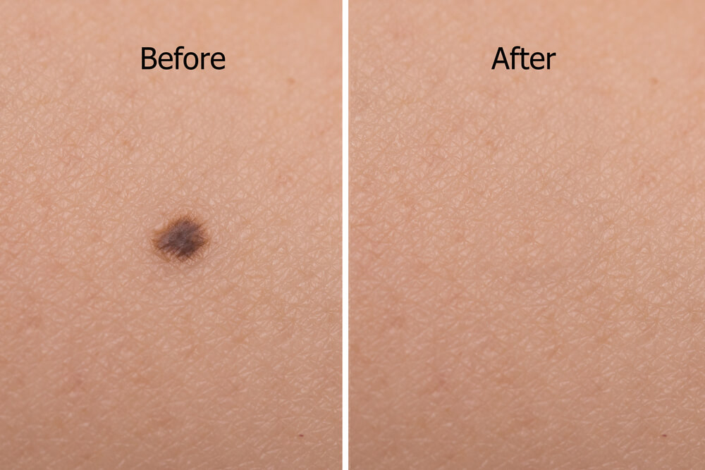 Before and after images showing the removal of a dark skin blemish. The left side displays a close-up of the blemish on light skin labeled "Before," while the right side shows the same area after treatment, with the blemish visibly diminished and the skin appearing smooth and clear, labeled "After." This comparison illustrates the effectiveness of skin treatment options for blemish removal.