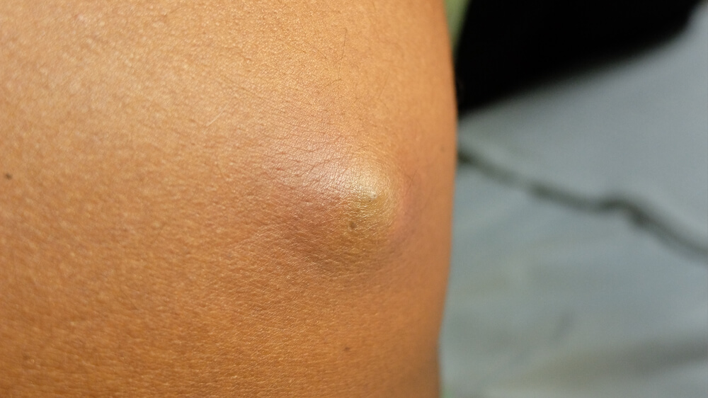 Sebaceous cysts