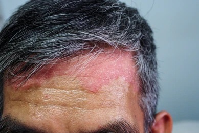 Close-up image of a man&apos;s forehead showing signs of skin irritation, including redness and raised patches. The man&apos;s hair is gray and short, and the focus is on the affected area of the skin. This image may represent conditions such as dermatitis or allergic reactions. It highlights the importance of skin health and the need for medical consultation for persistent skin issues.