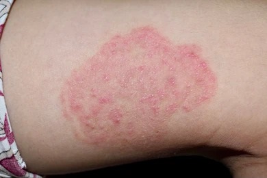 Close-up image of a red, inflamed patch of skin on a person's arm, showing symptoms of a skin condition. The area appears raised with a scaly texture, indicating possible eczema or psoriasis. The skin surrounding the affected area is healthy, highlighting the contrast. This image is useful for educational purposes related to dermatological conditions and skin health awareness.