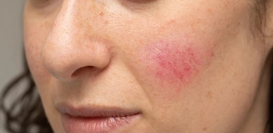 Close-up of a woman's face showing a red rash on her cheek, indicating a skin condition or irritation. The image highlights the texture and color variations of the skin, with visible freckles and natural facial features. This visual representation is useful for discussions on dermatological issues, skincare treatments, or personal health awareness.
