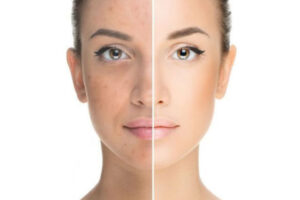 Benefits of laser skin resurfacing - Team Dermatology