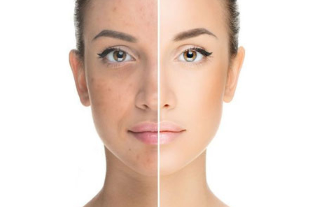 Benefits of laser skin resurfacing