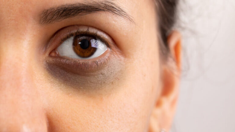 young lady with dark circles under her eye