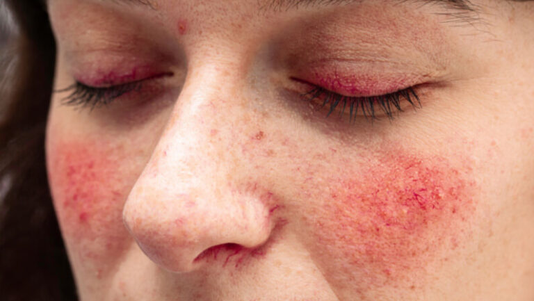 woman with red face