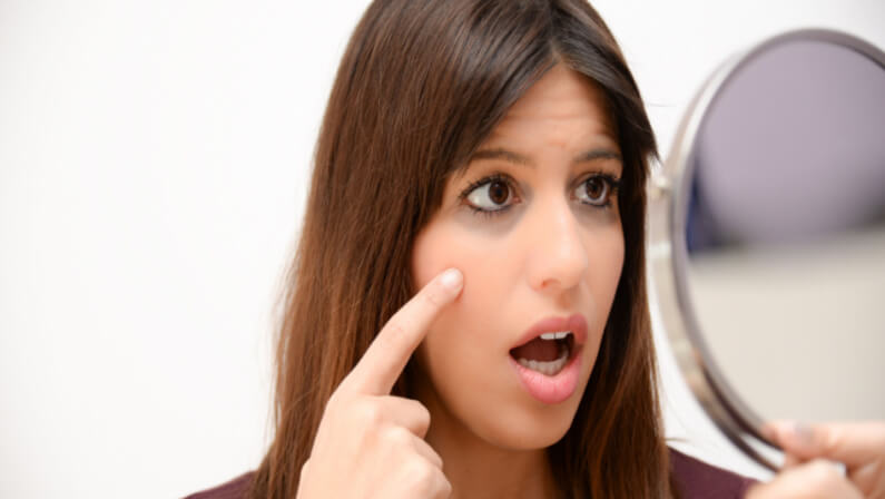young women with dark circles under eyes