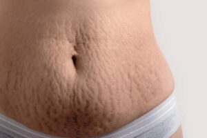 Skin Tightening for Sagging skin