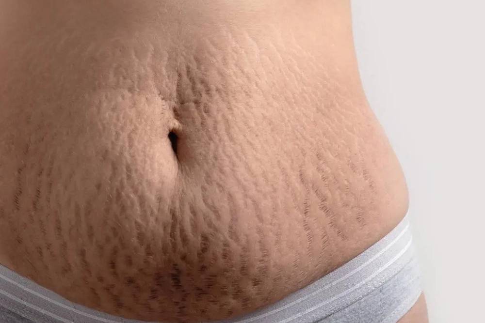 Skin Tightening for Sagging skin