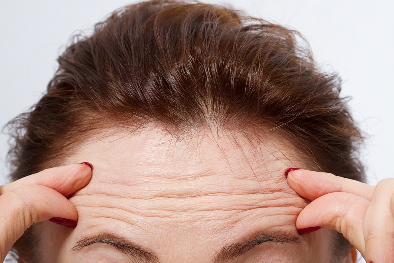 Close-up image of a woman with brown hair showing her forehead and frown lines. She is using her fingers to press against her forehead, highlighting wrinkles and signs of aging. The background is plain and light-colored, emphasizing the facial features. This image represents common concerns about aging skin and the effects of facial expressions on wrinkle formation. Ideal for discussions on skincare, anti-aging treatments, or cosmetic procedures.