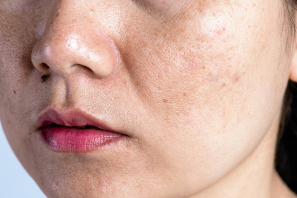 Skin Tightening for Sun Damages