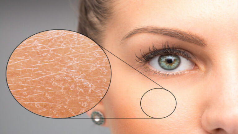 Ichthyosis