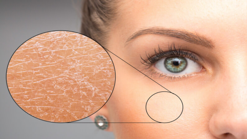 Ichthyosis
