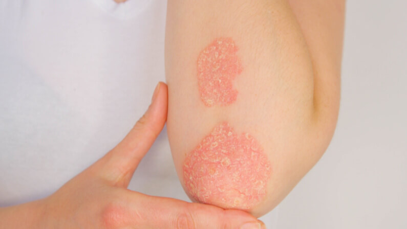 psoriasis on elbow