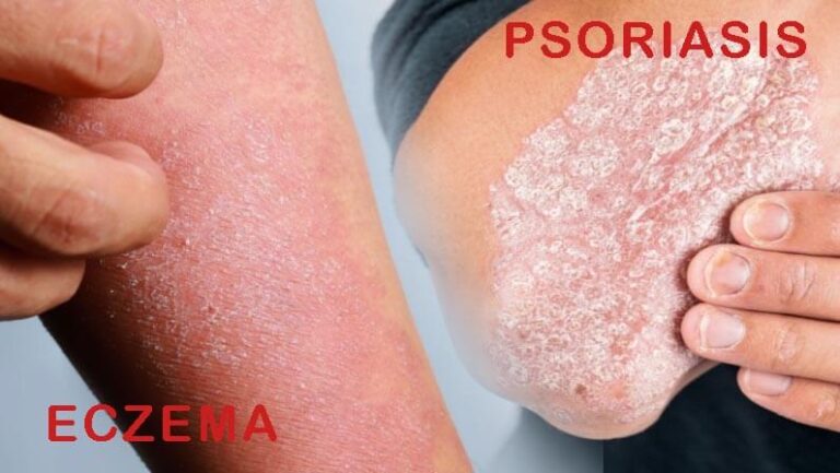 difference between eczema and psoriasis