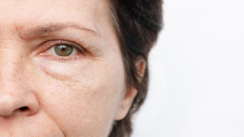Age-related skin changes