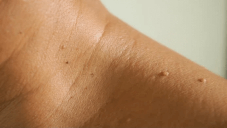 skin tags