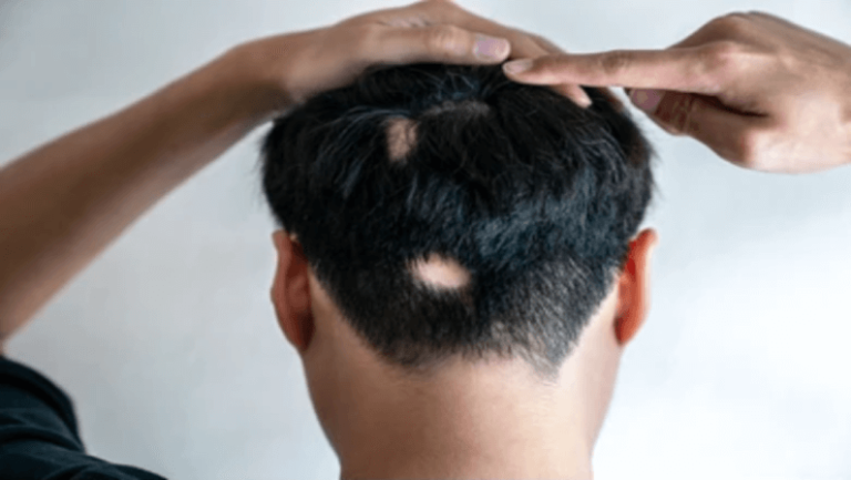male with Alopecia Areata