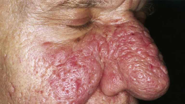 Rhinophyma
