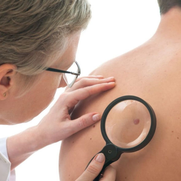 A healthcare professional examines a patient&apos;s back using a magnifying glass to inspect a mole or skin lesion. The image emphasizes the importance of dermatological check-ups for skin health and early detection of potential issues. The clinician&apos;s attentive approach highlights the role of regular skin assessments in preventive healthcare.