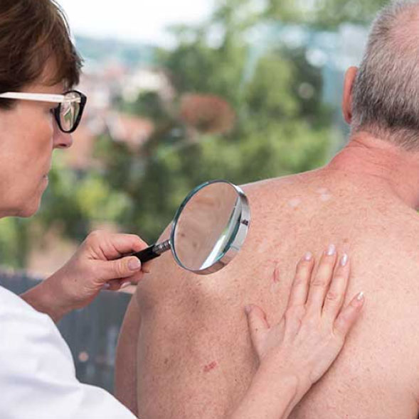 A healthcare professional examines a patient&apos;s back for skin conditions using a magnifying glass. The patient is seated outdoors, showcasing a relaxed environment. The image highlights the importance of regular skin checks for early detection of skin issues, including moles and lesions. This visual serves to promote awareness about skin health and the role of dermatological examinations in maintaining overall well-being.