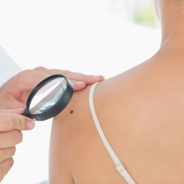 A healthcare professional examines a mole on a patient&apos;s back using a magnifying glass. The focus is on the skin condition, highlighting the importance of regular skin checks for early detection of potential issues. This image emphasizes skin health awareness and the role of dermatological assessments in preventive care.