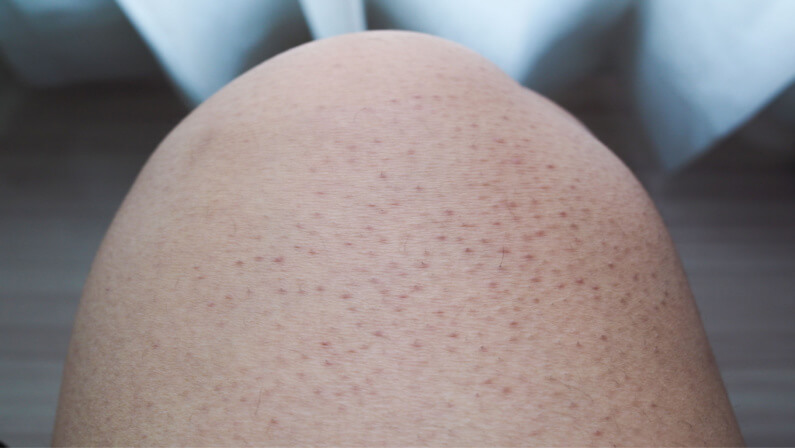 keratosis pilaris on a leg
