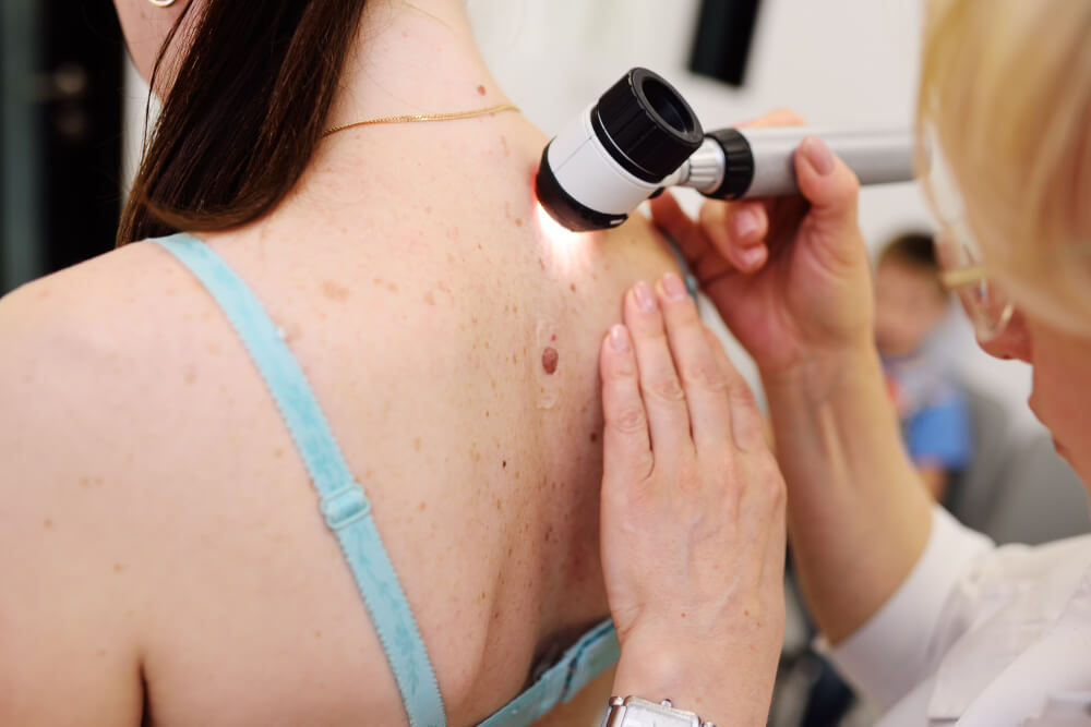 A healthcare professional conducts a skin examination on a patient&apos;s back using a dermatoscope. The patient, wearing a light blue strap, has various skin markings visible on their back. The examination takes place in a clinical setting, emphasizing the importance of regular skin checks for early detection of potential skin issues, such as melanoma or other skin conditions. This image highlights the role of dermatological assessments in maintaining skin health and promoting awareness of skin cancer prevention.
