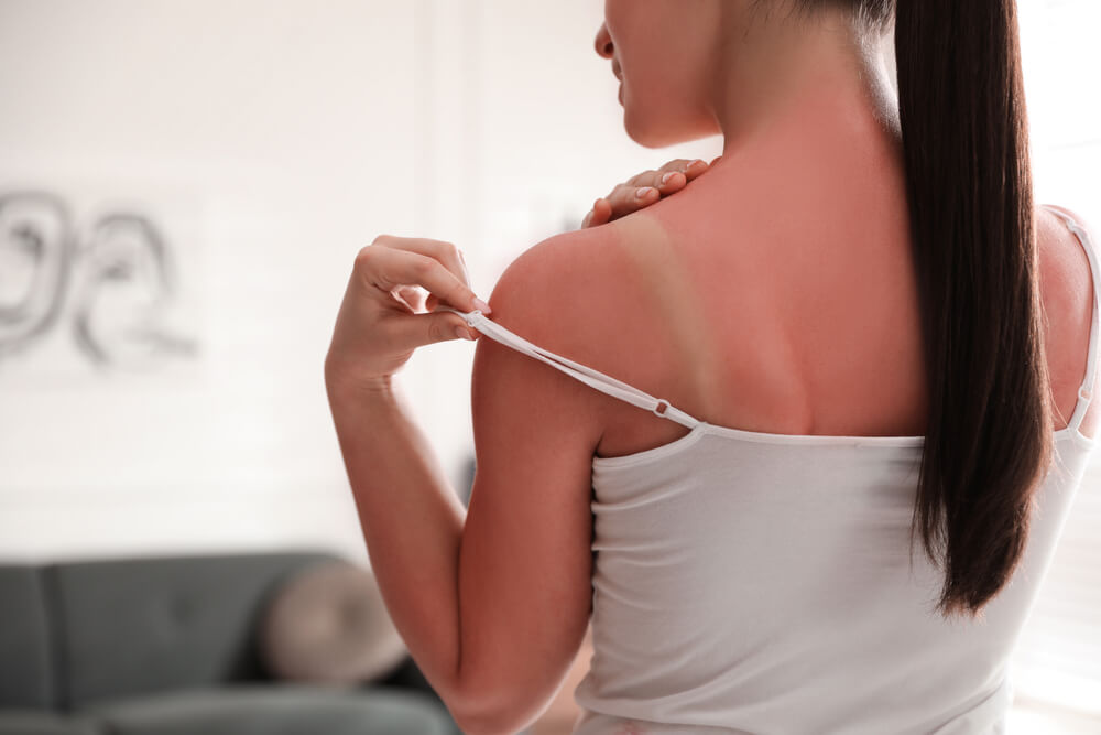 A woman with sunburned skin on her shoulders is adjusting her white tank top. The image highlights the contrast between the sunburned areas and the unaffected skin, demonstrating the effects of sun exposure. Soft natural light illuminates the scene, providing a clear view of the skin&apos;s condition. This visual serves as a reminder of the importance of sun protection and awareness of sunburn risks. Ideal for discussions on skincare, health, or sun safety tips.