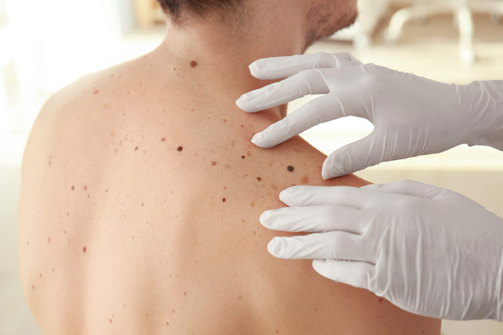 A healthcare professional wearing white gloves examines a patient&apos;s back, which is marked with various moles and skin spots. The setting appears to be a medical office, emphasizing the importance of regular skin checks for monitoring changes in moles. This image highlights skin health awareness and the role of dermatological assessments in early detection of skin conditions.