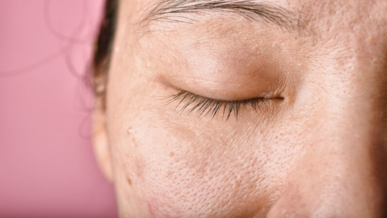 dehydrated skin