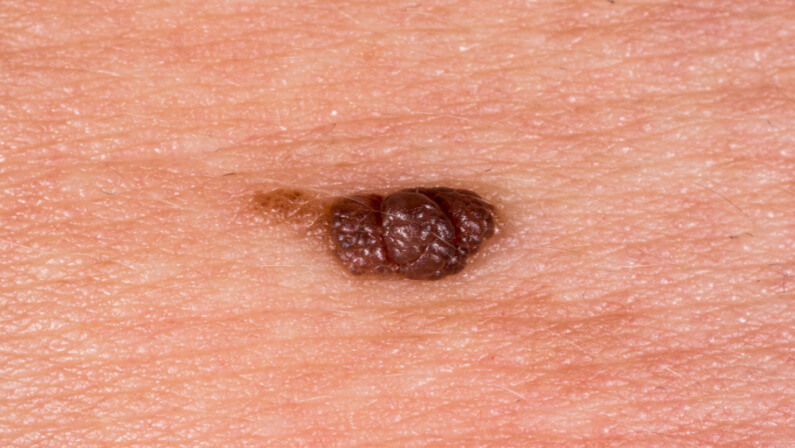 genital wart